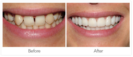 odontología Estética coronas dentales Fotos antes y después 