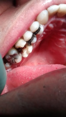 corona dental antes (1)