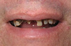 corona dental antes