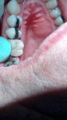 corona dental despues restauracion