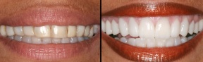 Corona dental zirconio estetica dental