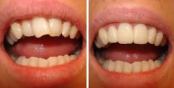 Enderezar dientes torcidos sin ortodoncia caso despues