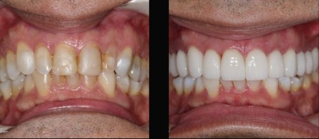 Coronas dentales circonio porcelana antes despues- Medellin Colombia