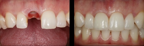 Implante-dental-caso-Medellin-Colombia