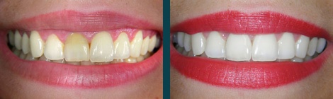 Carillas dentales en porcelana antes y después 2